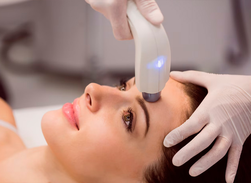 Laser o peelings descubre cual es el tratamiento ideal para manchas faciales